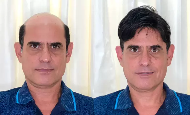 C2 antes-e-depois-01-protese-capilar-em-salvador