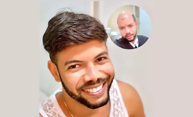 C2 antes-e-depois-02-protese-capilar-em-salvador