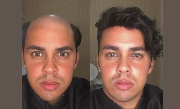 C2 antes-e-depois-04-protese-capilar-em-salvador