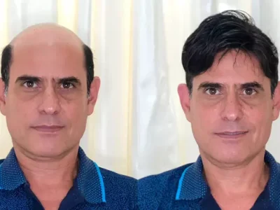 Prótese Capilar em Salvador: Antes e depois com preenchimento e densidade