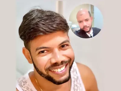 Resultado de Prótese Capilar em Salvador: Antes e Depois Rejuvenescimento