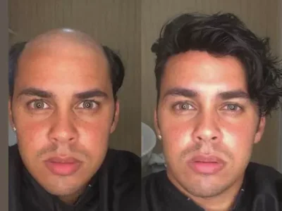 Antes e Depois de Prótese Capilar em Salvador: Transformação e Resultado Natural